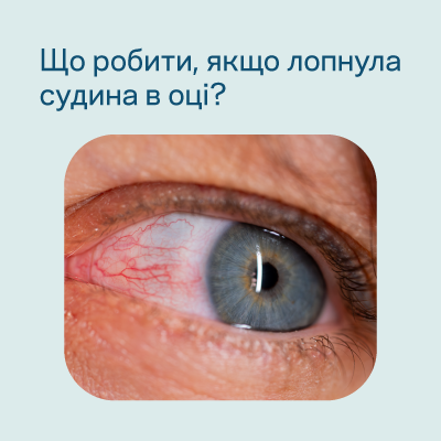 Лопнула судина в оці: чи небезпечно це? Причини та лікування крововиливу в око