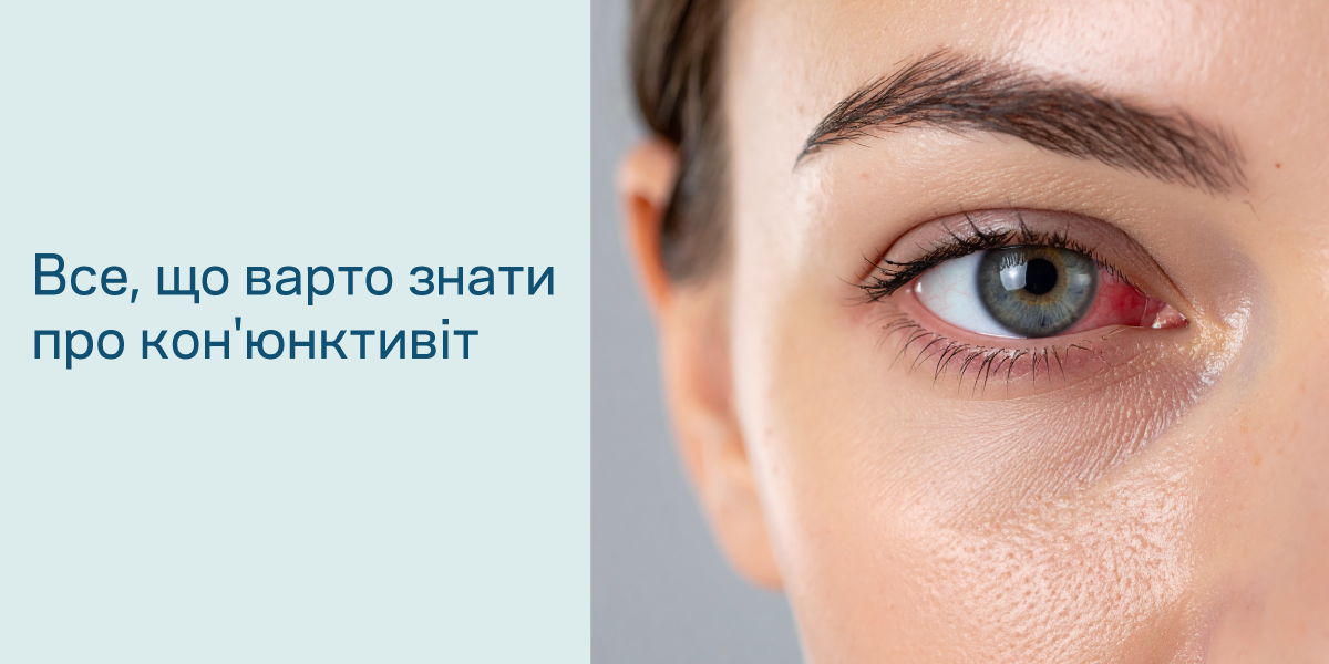 Конъюнктивит: виды, симптомы и лечение воспаления глаз